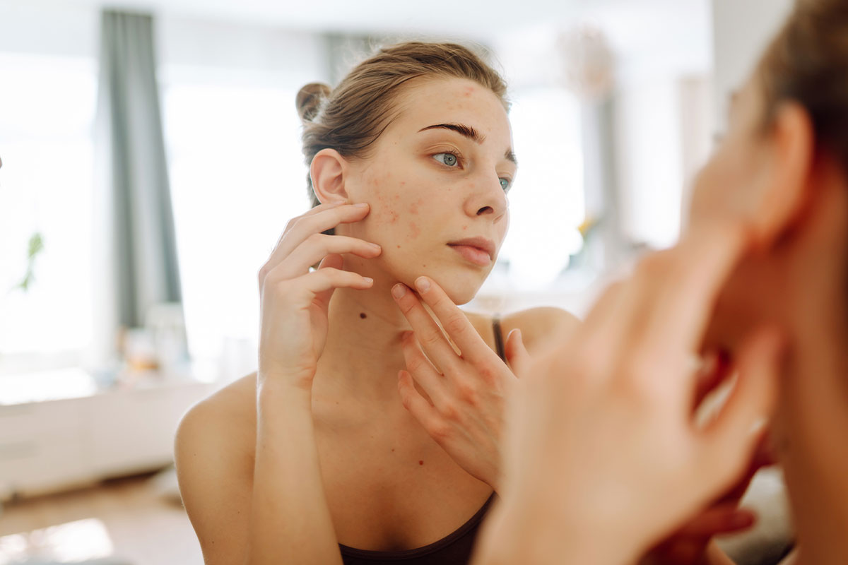 The Real Reason Adult Acne Keeps Coming Back: